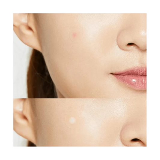 Acne Pimple Master 24 patches