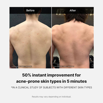 RED Acne Body Wash 2.0 - purifica y alivia el acné (400 g)