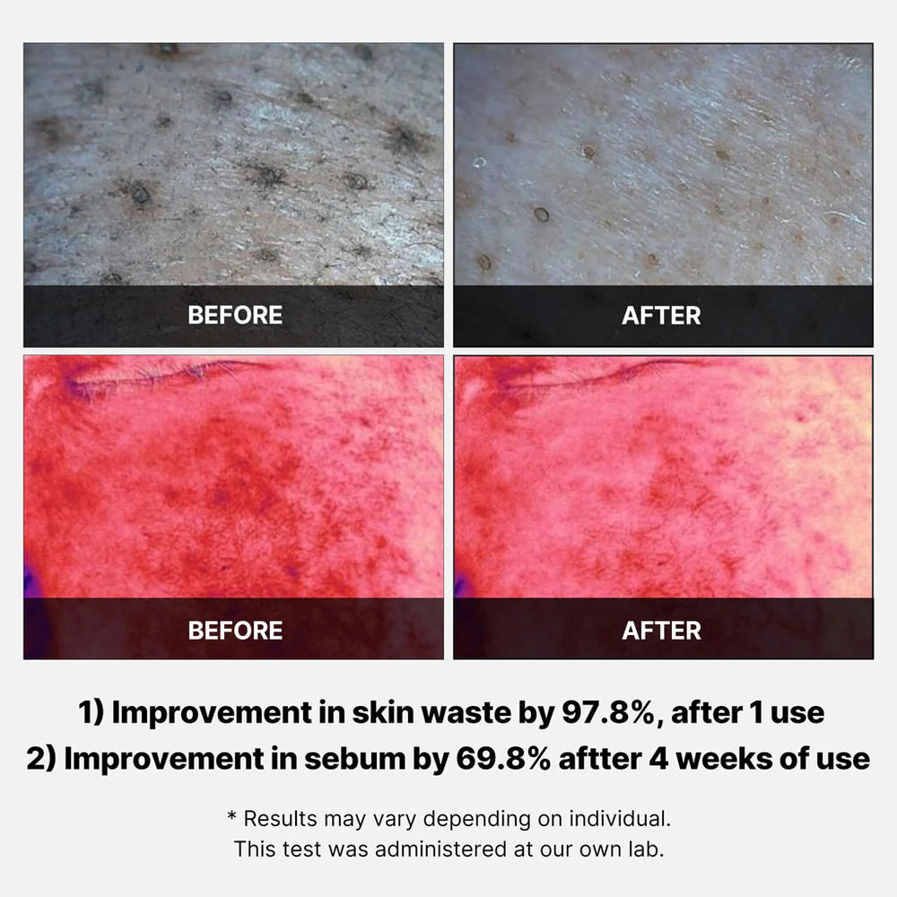 Red Succinic Acid Peeling Pad (70 stuks): purifican y alivian