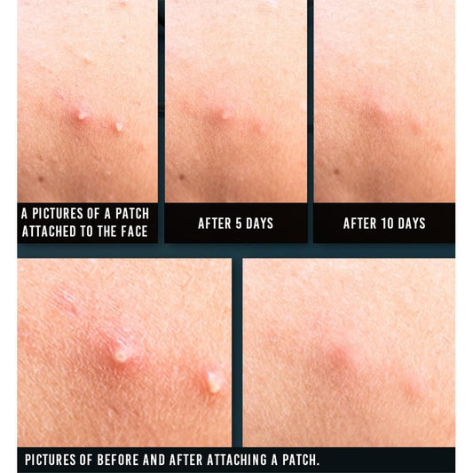 ACNE Spot Patch Super Thin (15 st)- reduce la inflamación