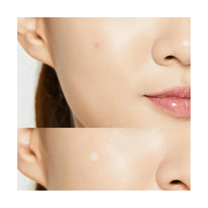 Acne Pimple Master 24 patches